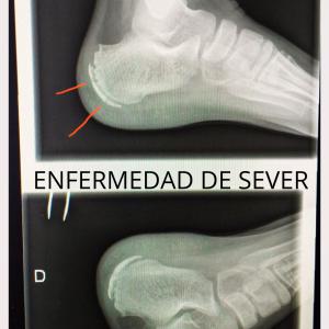 enfermedad de server